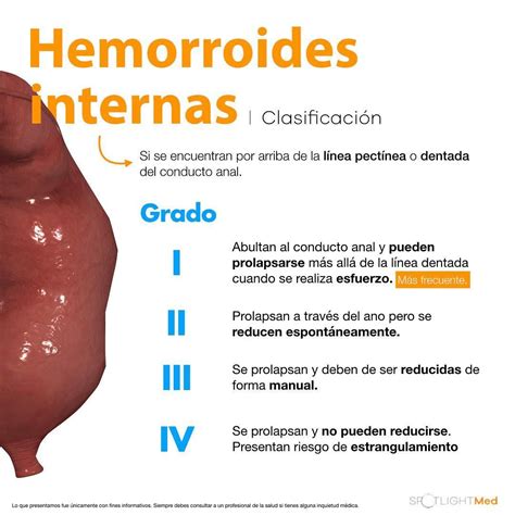 fotos reales de hemorroides|Fotos de hemorroidas (externas, internas e trombose)